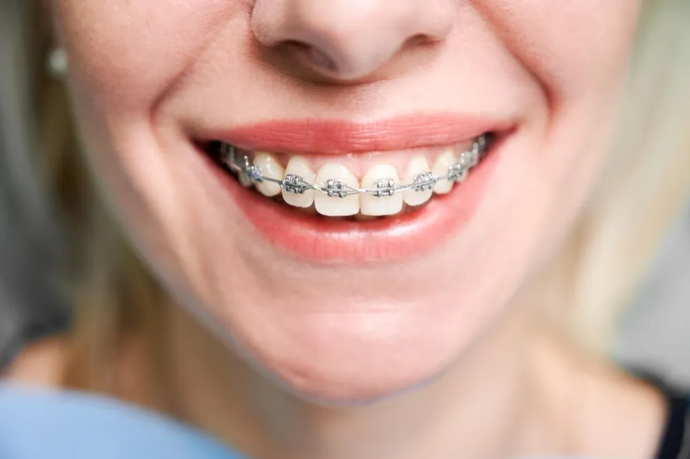 Orthodontic Braces Treatment in Diva Thane for Correcting Teeth Alignment