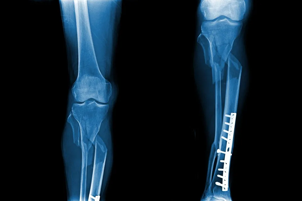 Advanced Fracture Management in Moshi for Better Bone Healing and Recovery