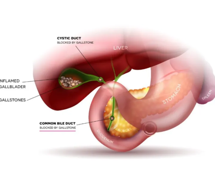 Bile Duct Stones Treatment Specialist in PCMC for Precision Diagnosis and Effective Biliary Care