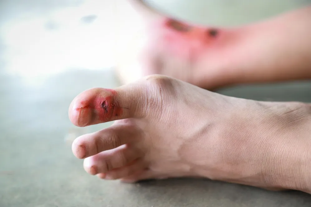 Amputation And Diabetic Wound Management Surgeon in Byculla Timely Care Can Prevent Bigger Complicat
