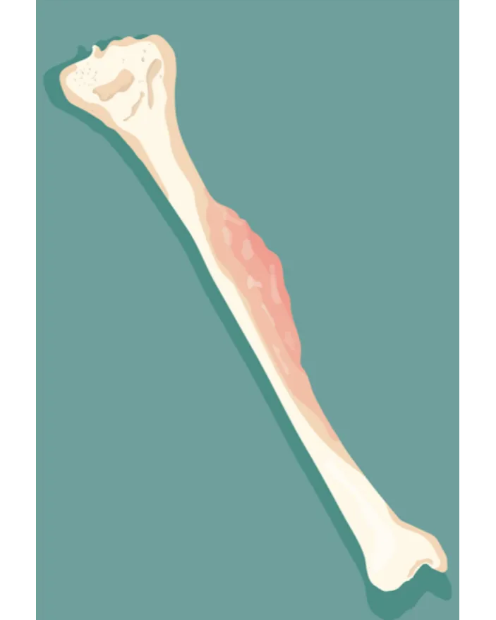 Bone Cancer Treatment in Mumbai Focused on Early Diagnosis and Recovery Planning