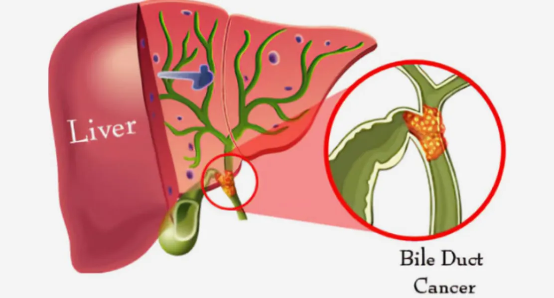 Bile Duct Cancer Treatment Specialist in PCMC for Advanced Hepatobiliary Cancer Management