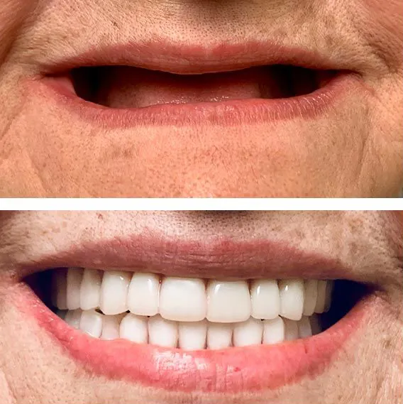 Restoring Smiles and Confidence: The Power of Dentures at Pratham-Harsh Dental Clinic.