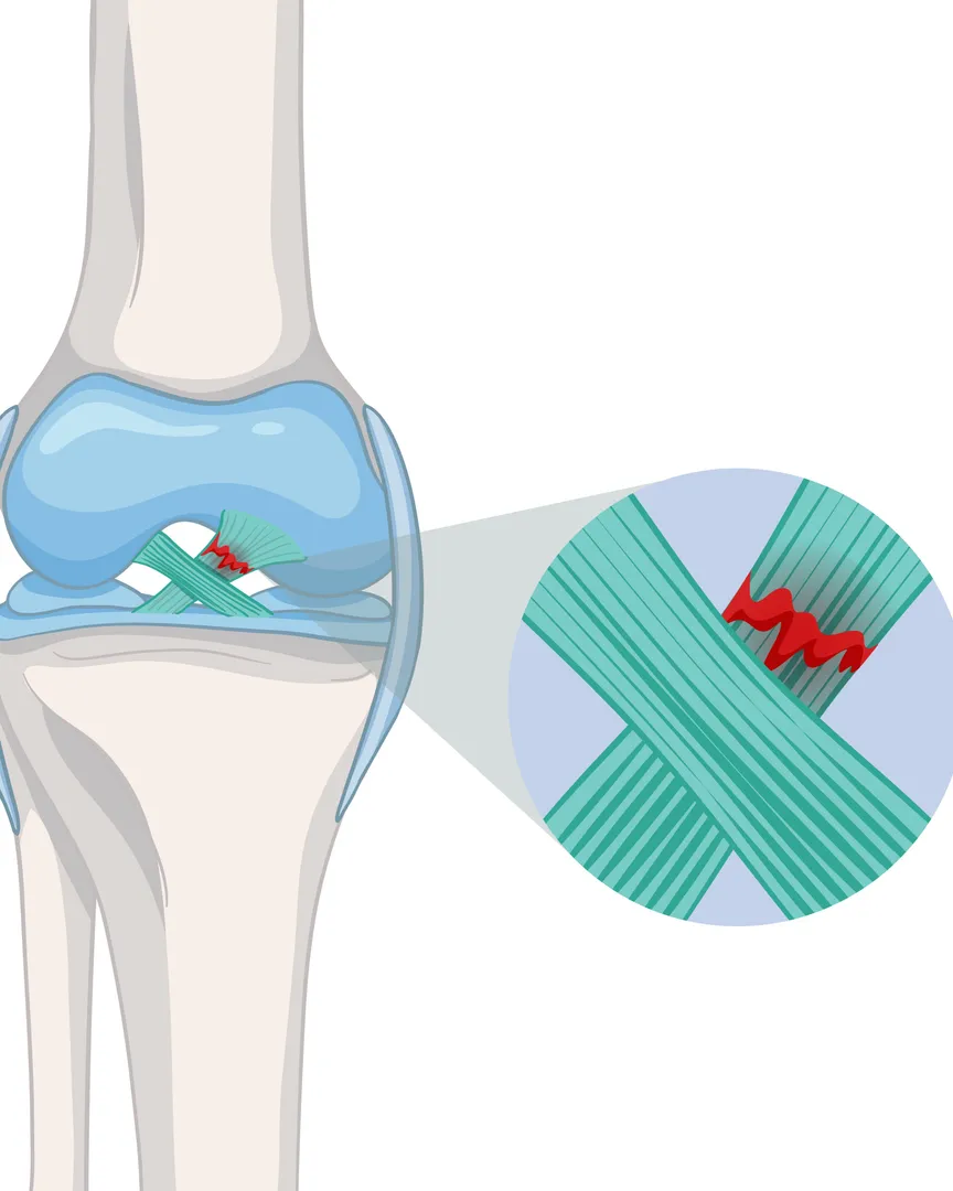 Ligament Injury Treatment and Recovery in Noida for restoring strength and joint stability