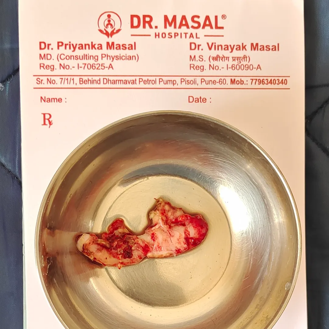 Laparoscopic appendicectomy at Dr Masal Hospital pisoli Pune