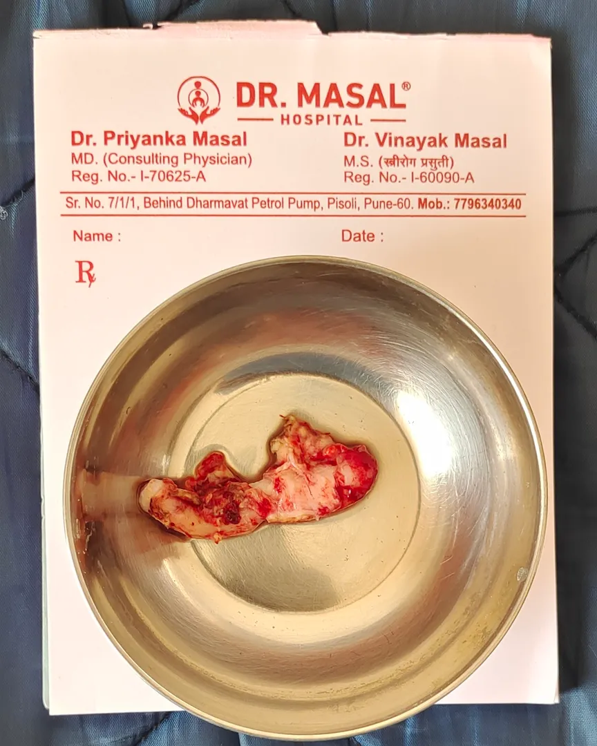 Laparoscopic appendicectomy at Dr Masal Hospital pisoli pune