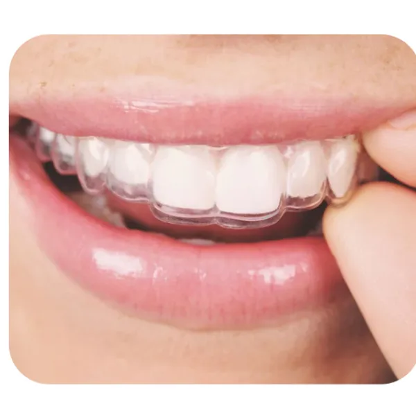 Clear Aligners in Thane: Treatment Timeline, Cost & Results