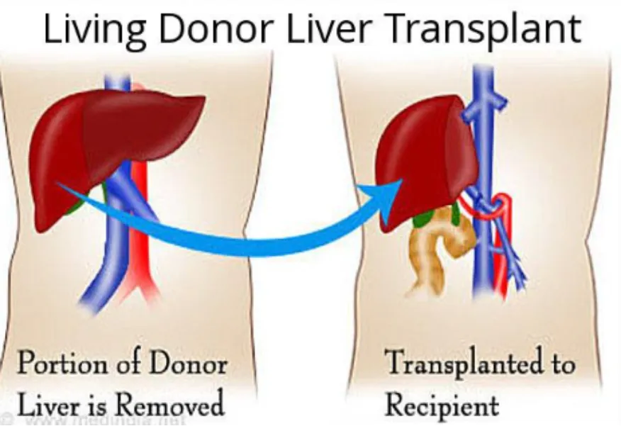 Living Donor Liver Transplant Specialist in PCMC – A New Hope for Advanced Liver Disease