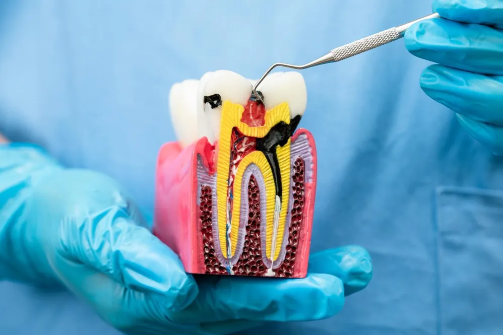 Root Canal Treatment in Sarjapur Road