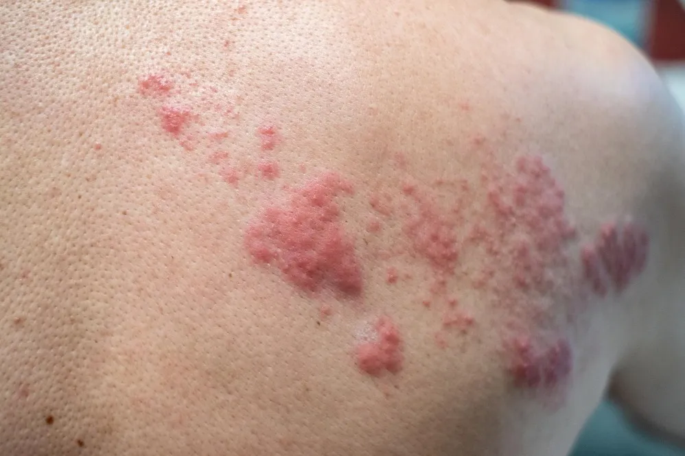 Ayurvedic Treatment for Skin Problems in Pune