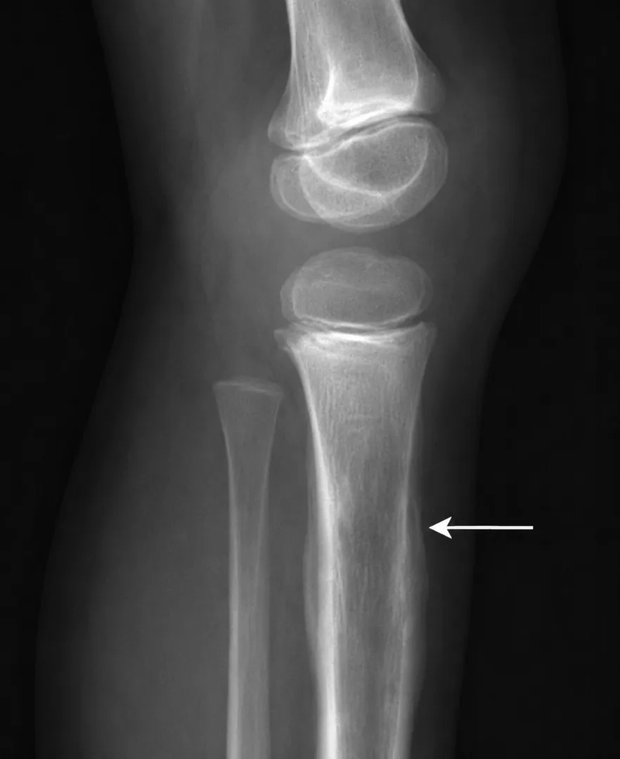 Ewing Sarcoma Care in Mumbai Focused on Early Attention and Recovery Guidance