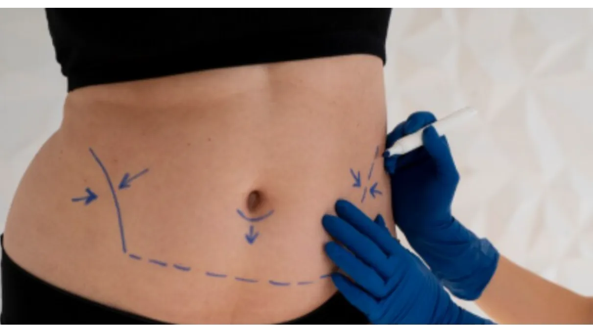 Liposuction Surgery in Camp Pune for Body Contouring and Shape Refinement