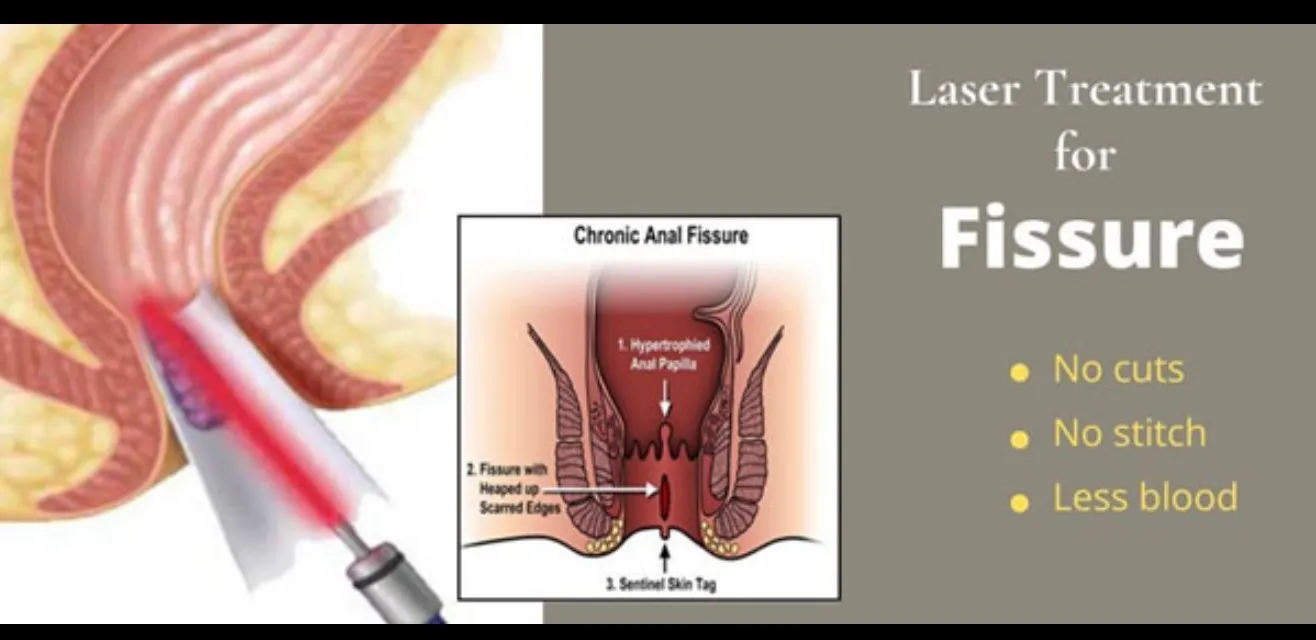 Laser Fissure Surgery in Chinchpokli with Advanced Care Approach