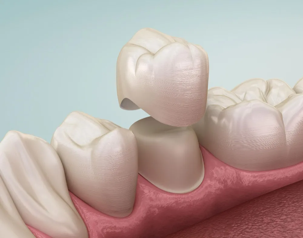 Lifetime Warranty Dental Caps in Kammanahalli Long-Term Protection for Your Restored Teeth