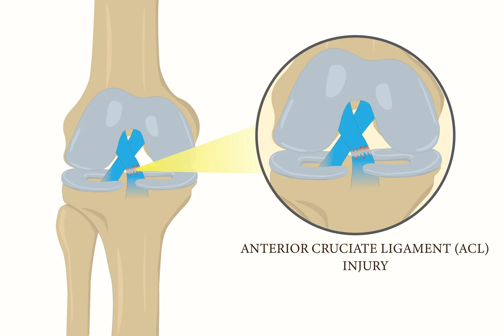 Ligament Reconstruction ACL/PCL Surgeries in Dadar