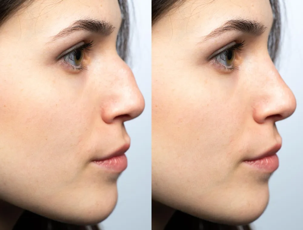 Nose Job Surgeon in Pune