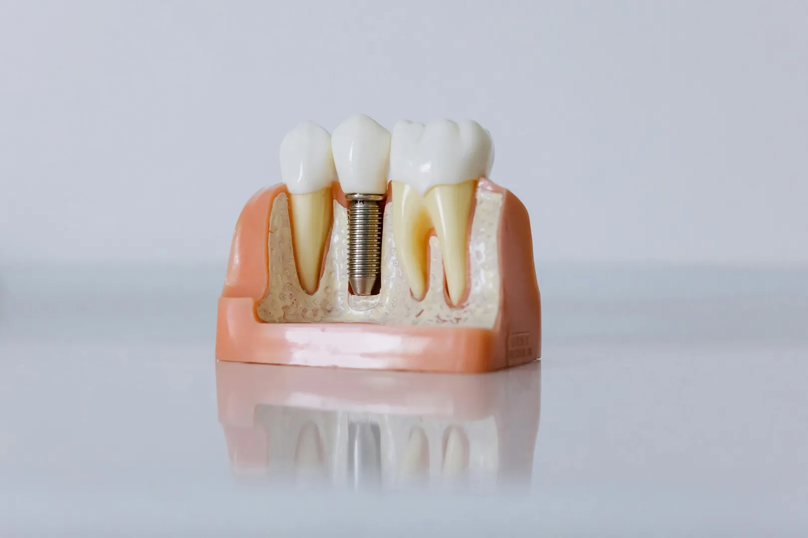 Best Affordable Implants Near Me In Sikka Nagar Mumbai