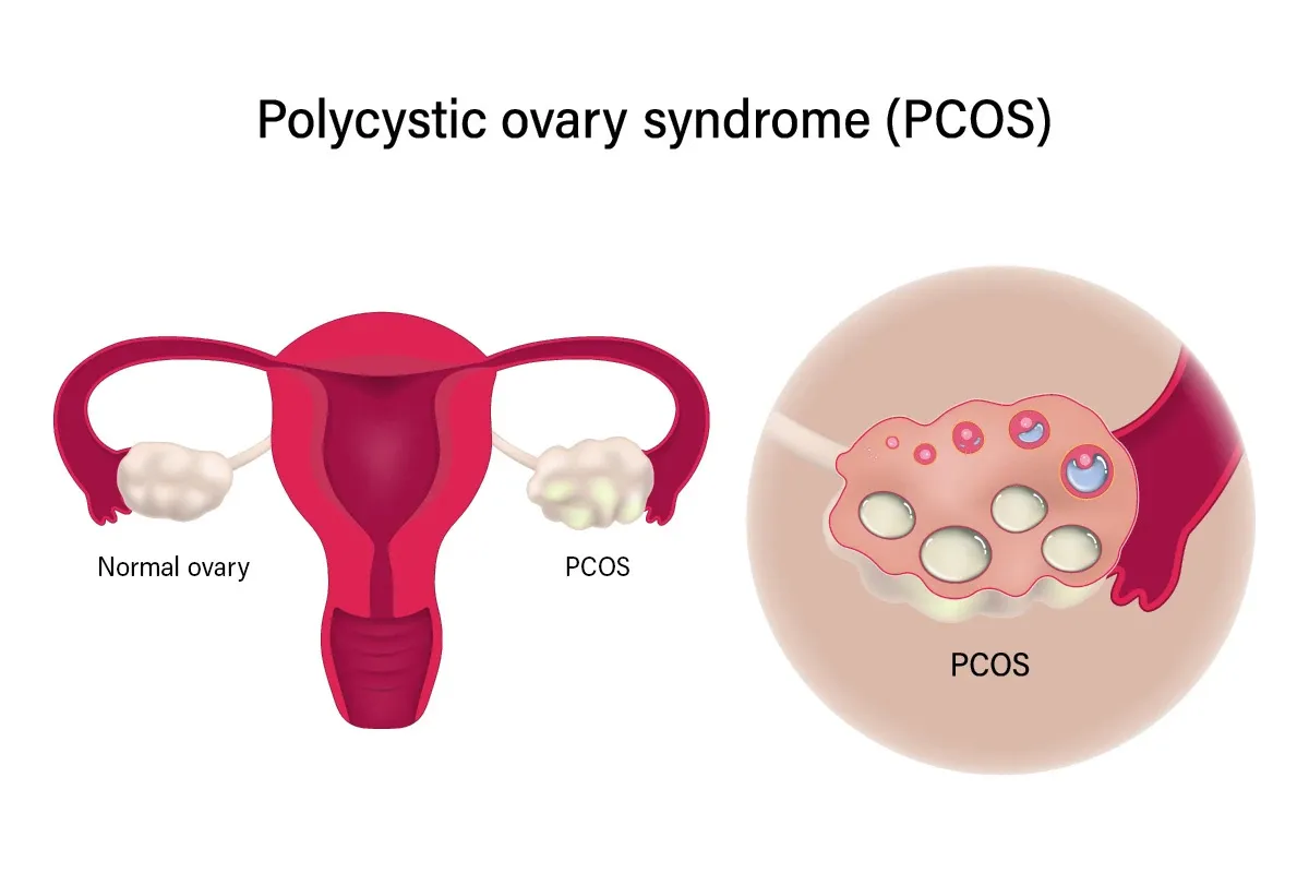 pcos treatment in nerul