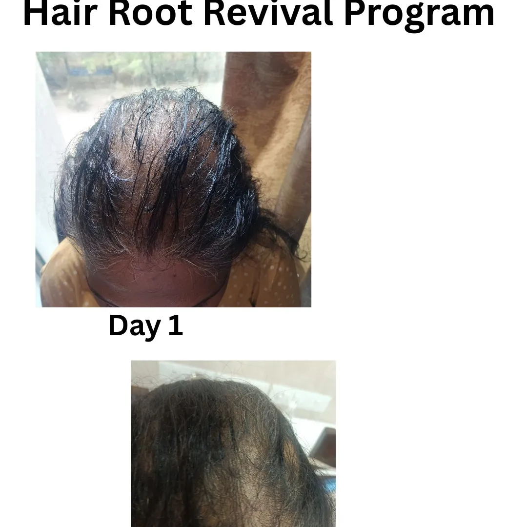 Best Ayurvedic Hair Treatment Center in Vartak Nagar