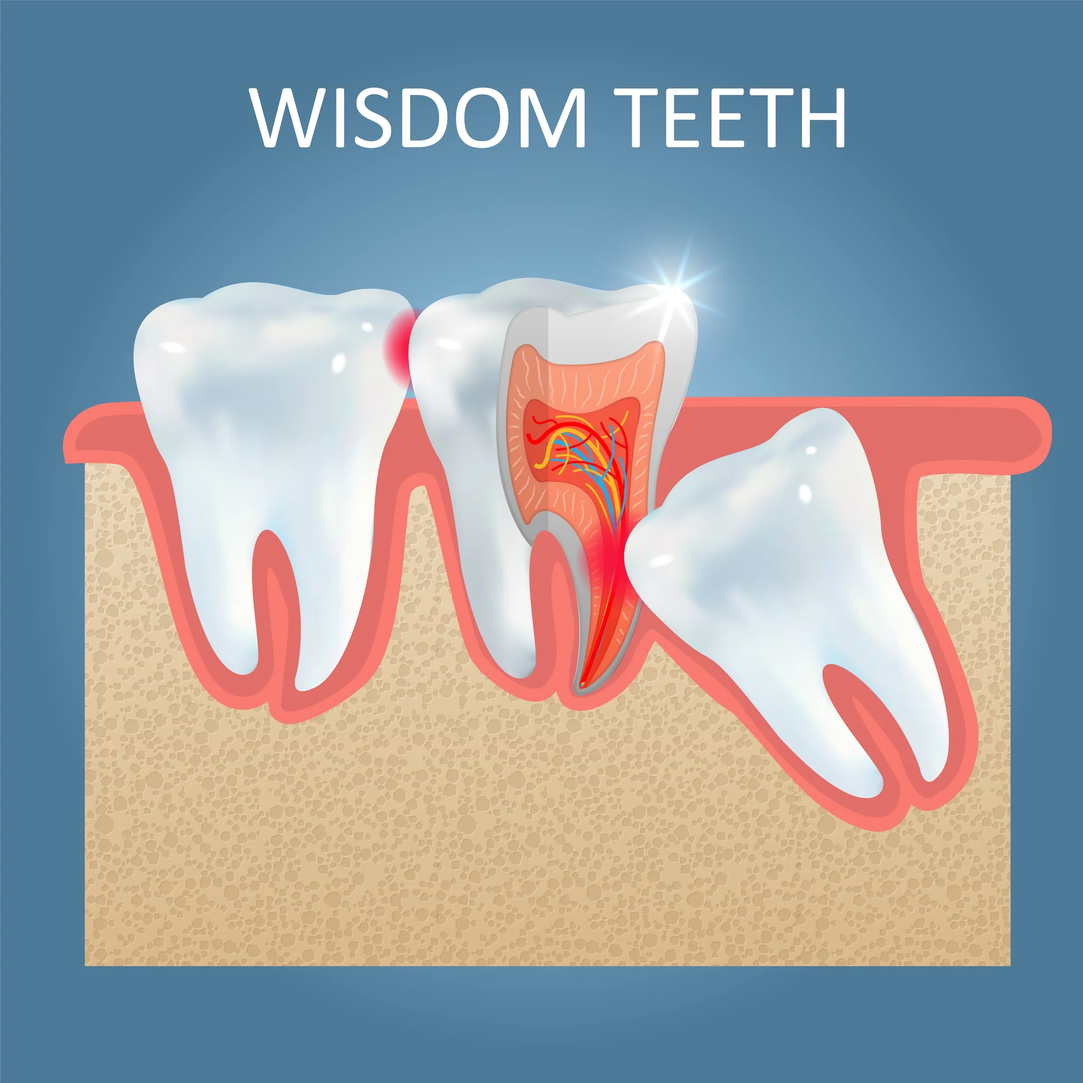 Wisdom Tooth Removal Treatment in Wagholi