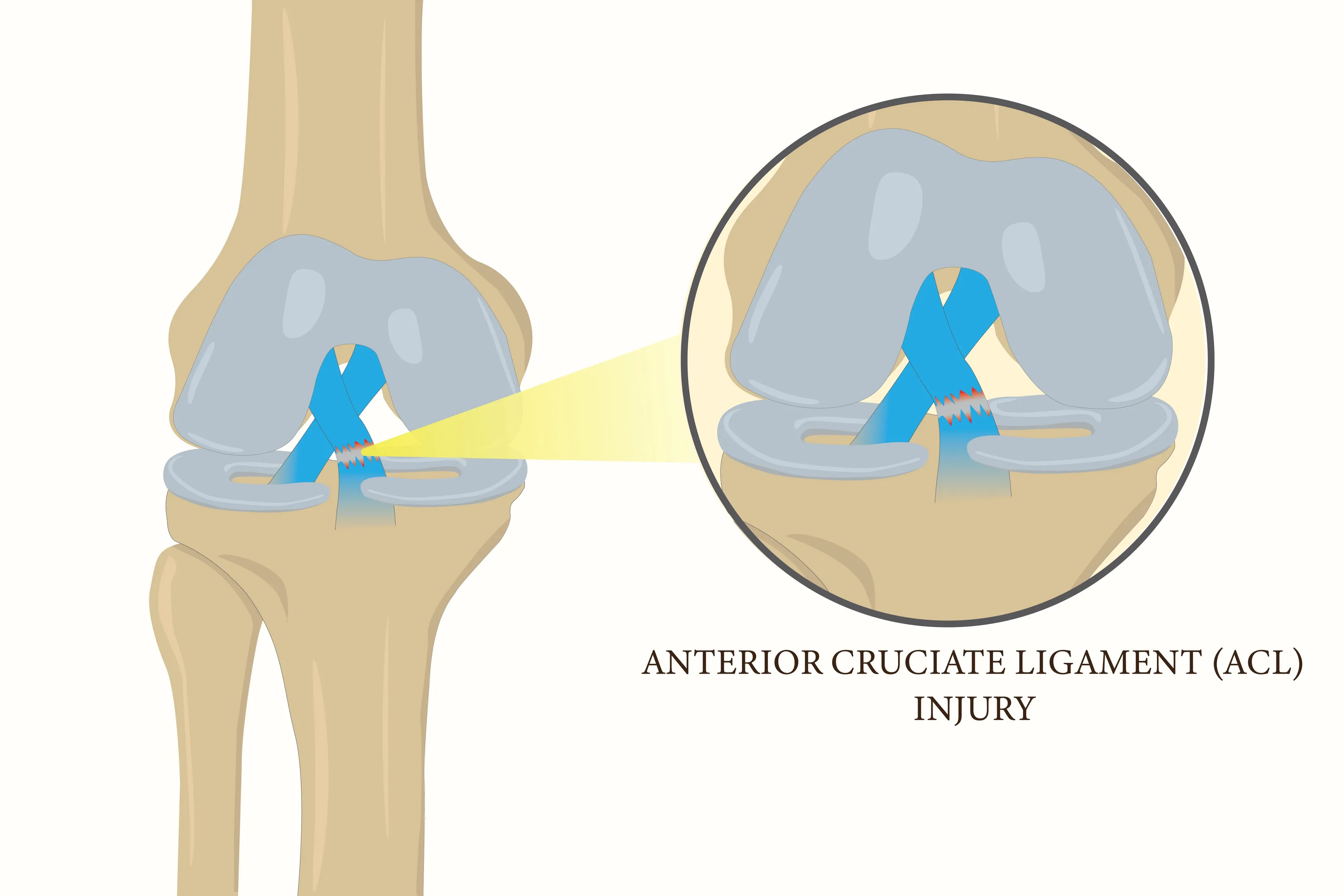 ACL Surgery Hospital in Pune