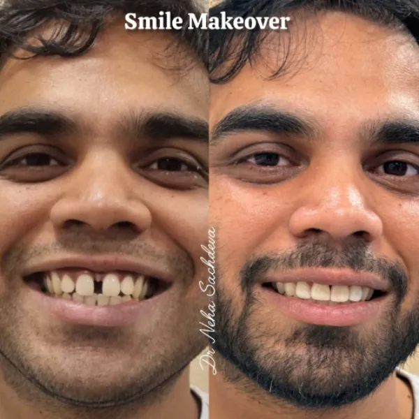 Smile Makeover Specialist in Greater Kailash I – When a Better Smile Changes More Than Just Appearan