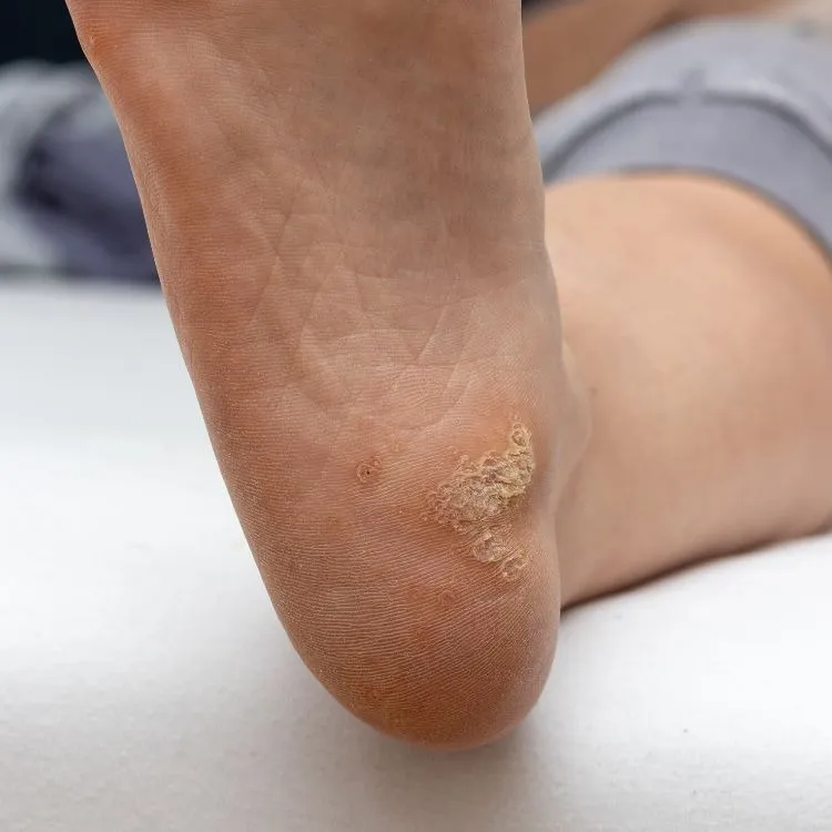 Removal of Plantar Warts at Rakesh Reddy's Skin Clinic in Sanjay Nagar