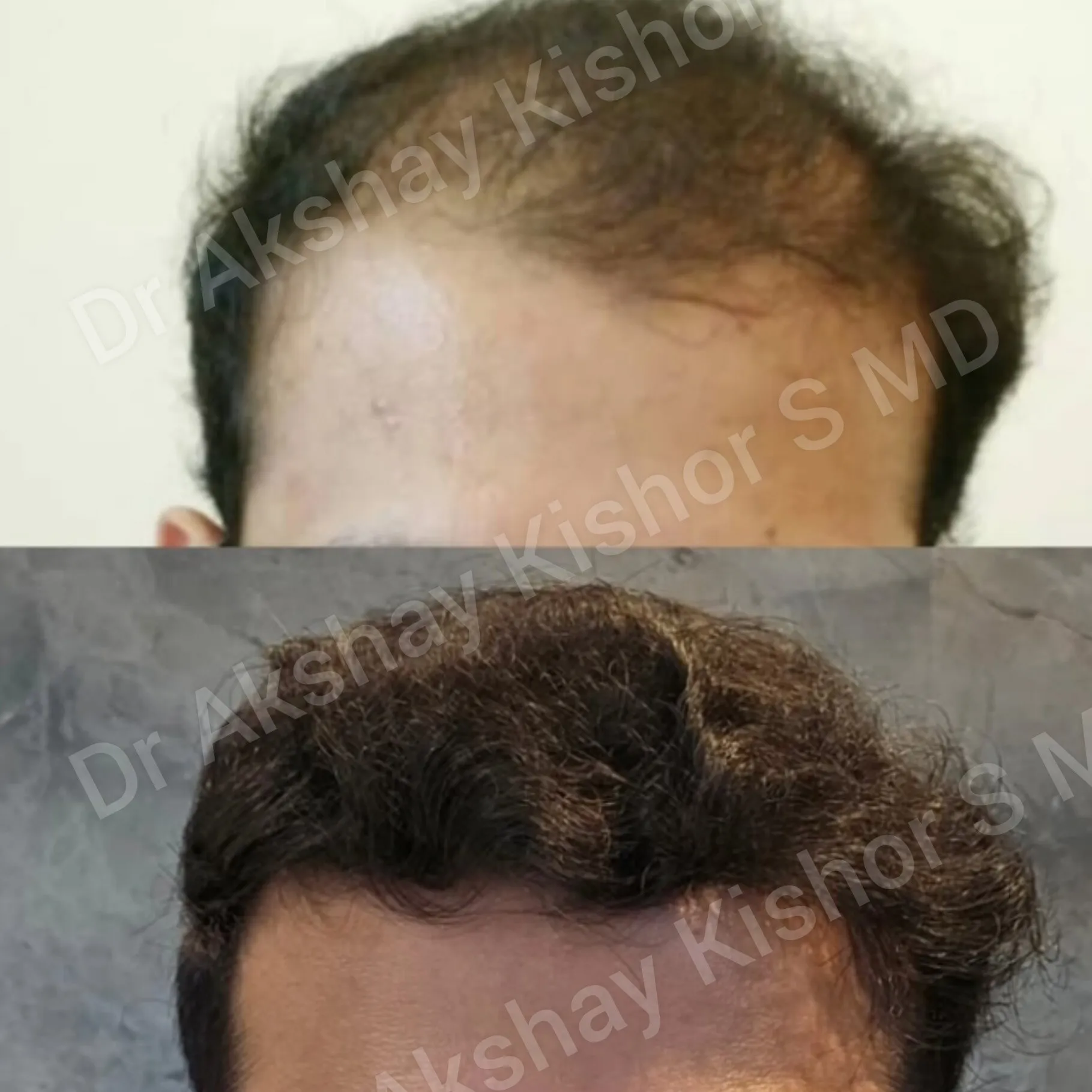 Best Hair Specialist in South Mumbai
