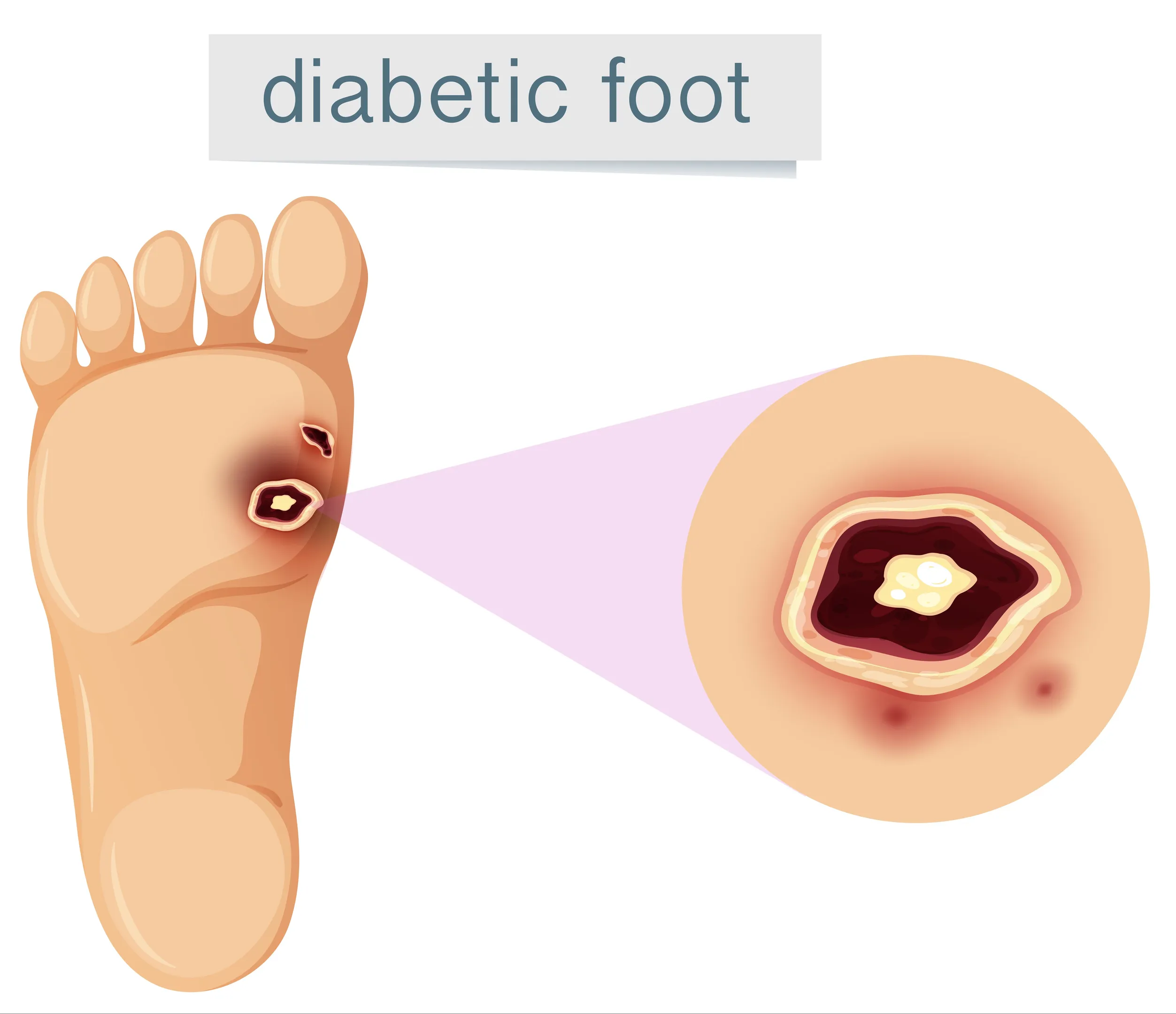 Diabetic Foot Ulcer Treatment in Vashi for Faster Healing and Better Foot Protection