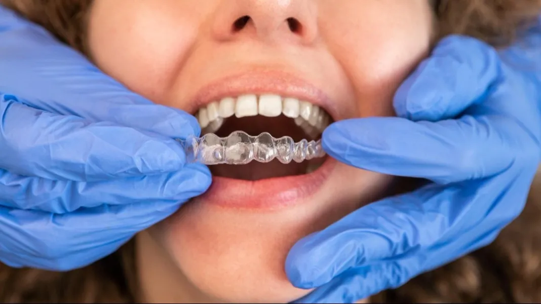 Invisalign Provider in East of Kailash – Straightening Teeth Without Changing Your Lifestyle