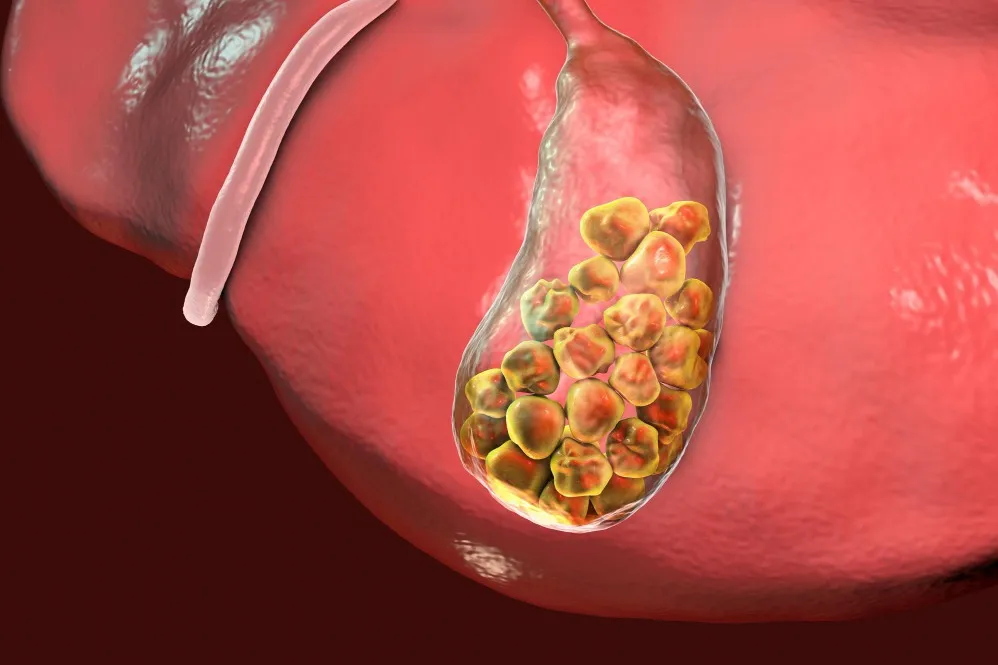 Gallbladder Stone Treatment Specialist in PCMC – When Gallstones Begin to Affect Daily Life