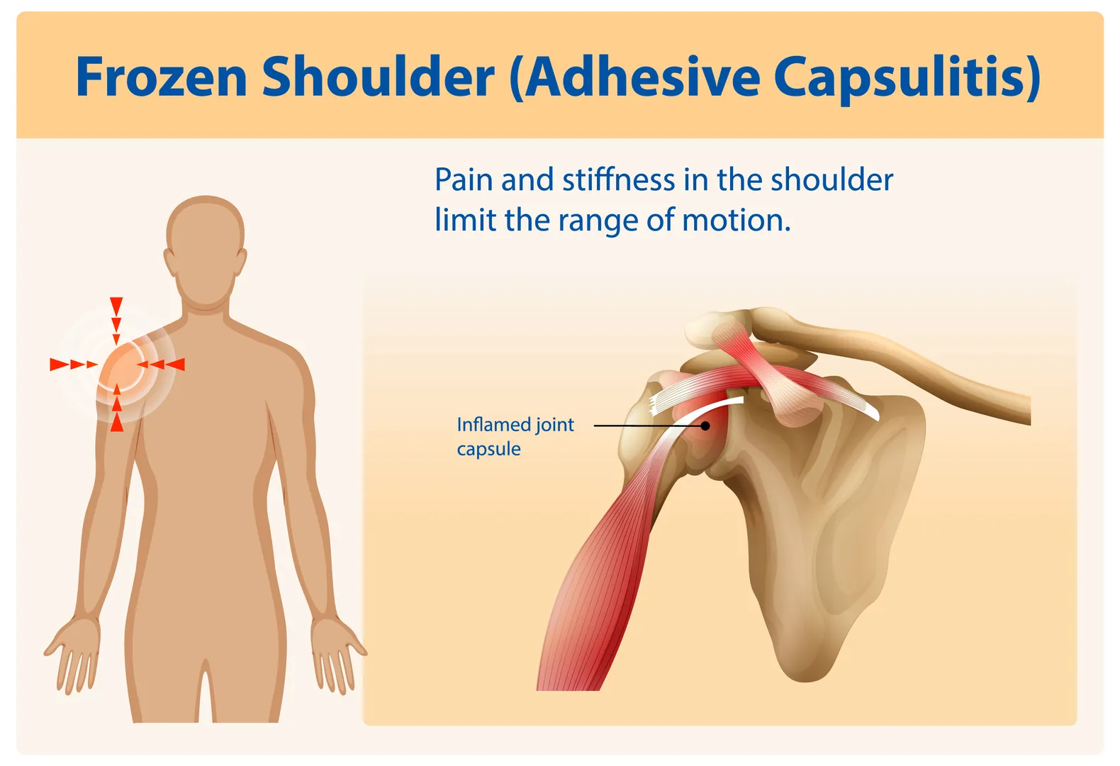 Frozen Shoulder Treatment Centres in Nagarbhavi