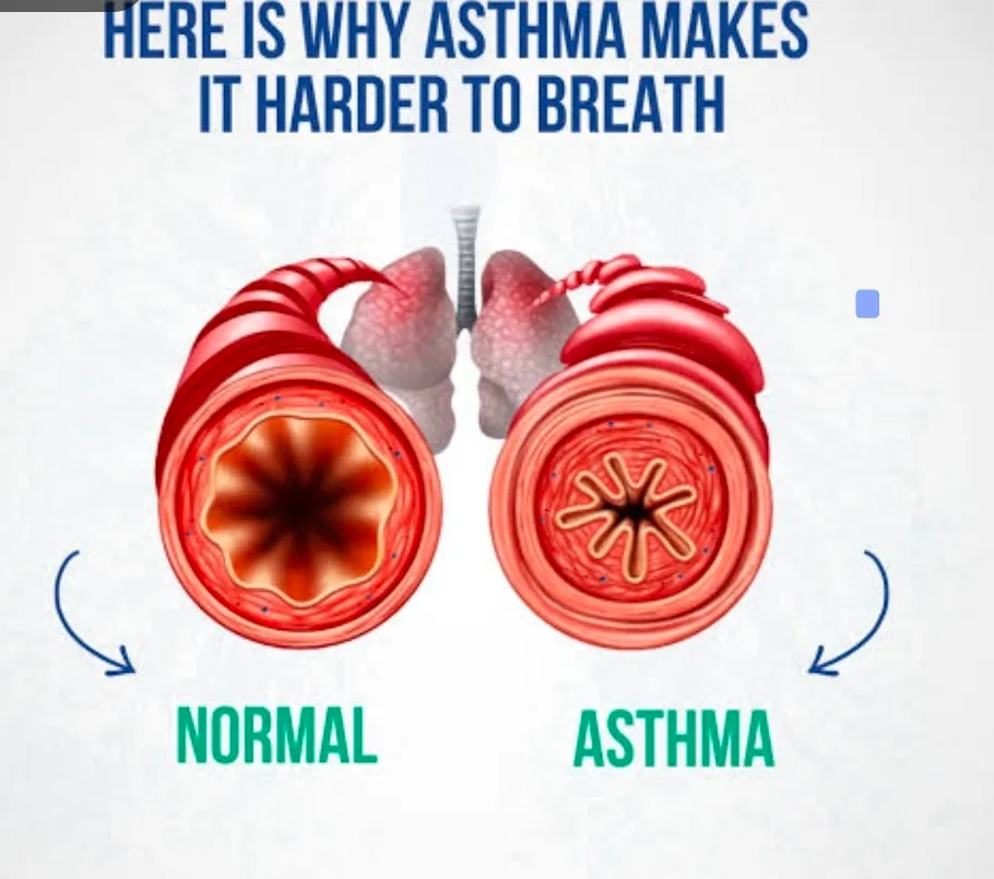 Asthma specialist in jaipur
