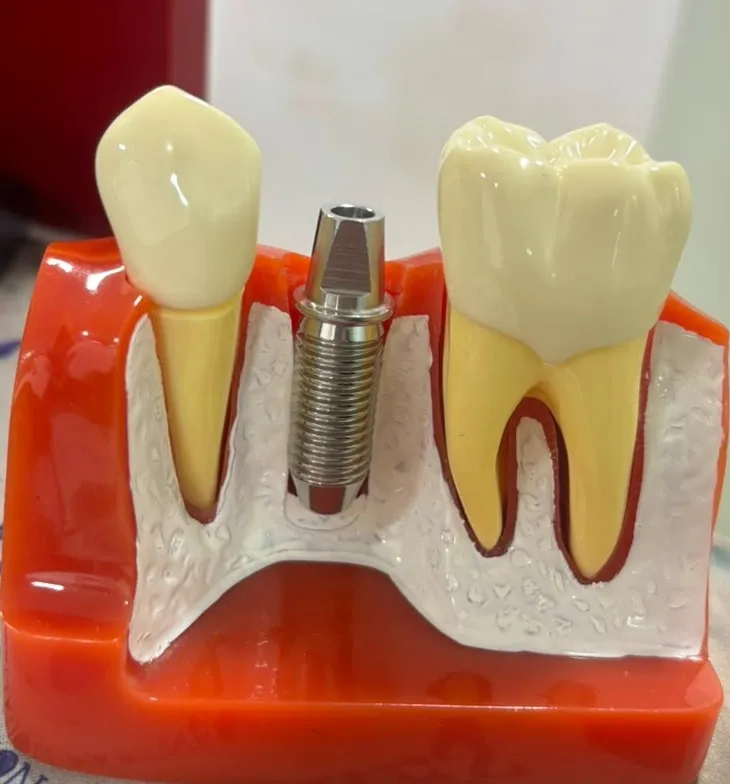 Best Dentist in Thane (Nitin Company) for Dental Implants: What Patients Should Know
