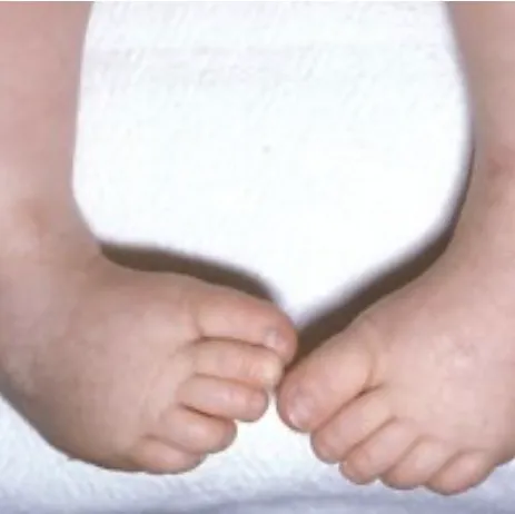 Pediatric Physiotherapy In Valasaravakkam, Chennai