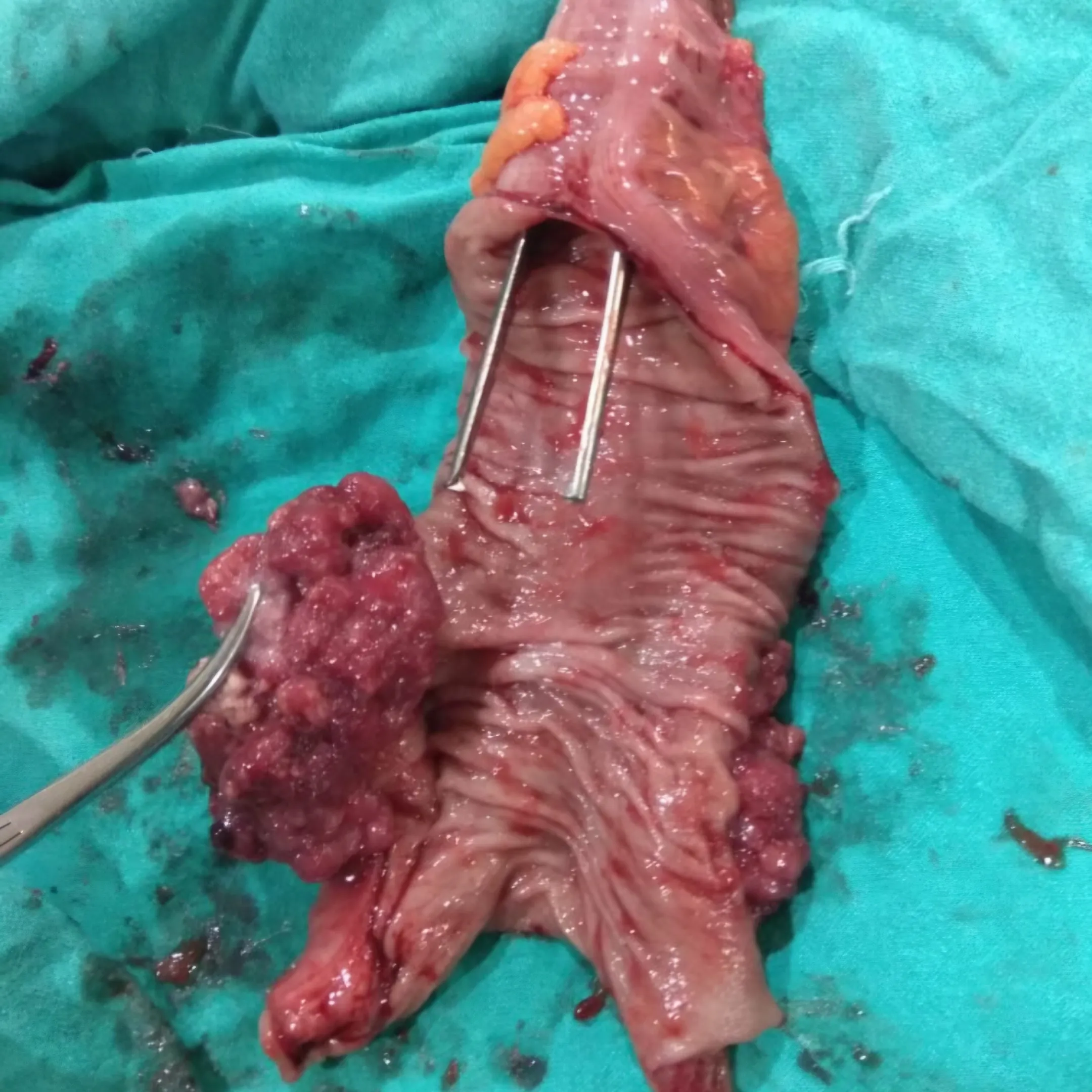 adenocarcinoma rectosigmoid