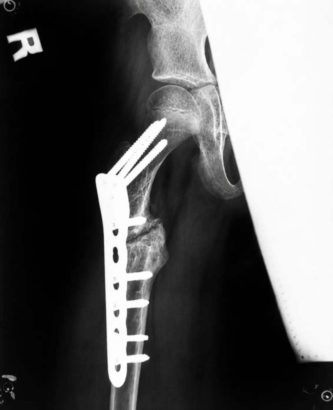 Megaprosthesis Surgery in Mumbai Supporting Limb Reconstruction After Bone Tumor Surgery