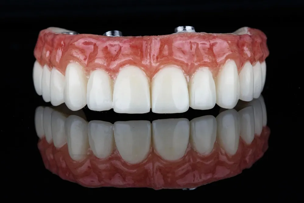 Affordable Full Mouth Dental Implants in Delhi for Complete Smile Restoration