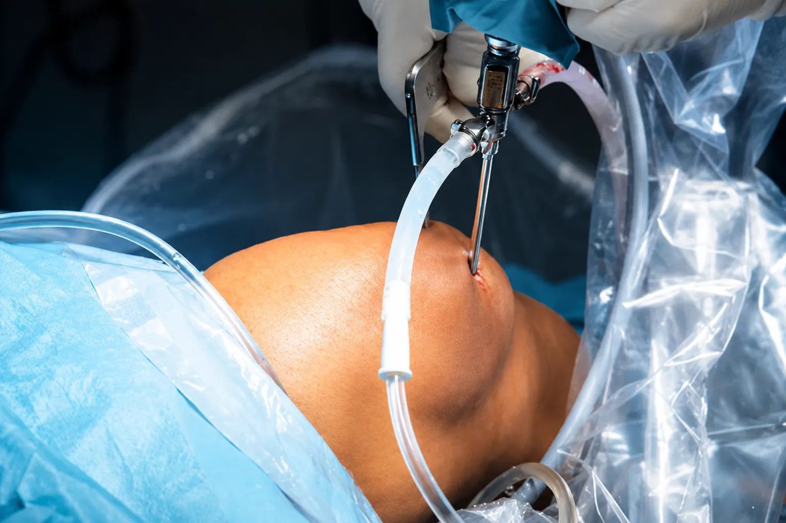 Limb Salvage Surgery in Mumbai Focused on Preserving Mobility and Everyday Independence