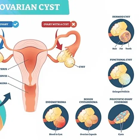 ovarian cyst treatment in nerul
