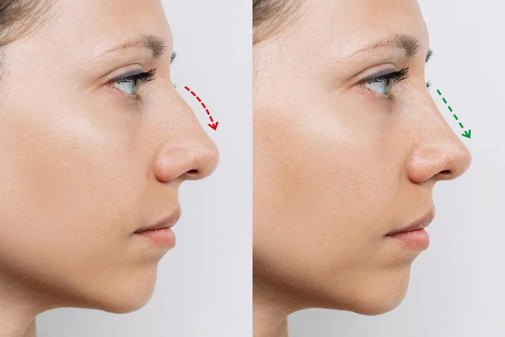 Rhinoplasty Surgery in Pune