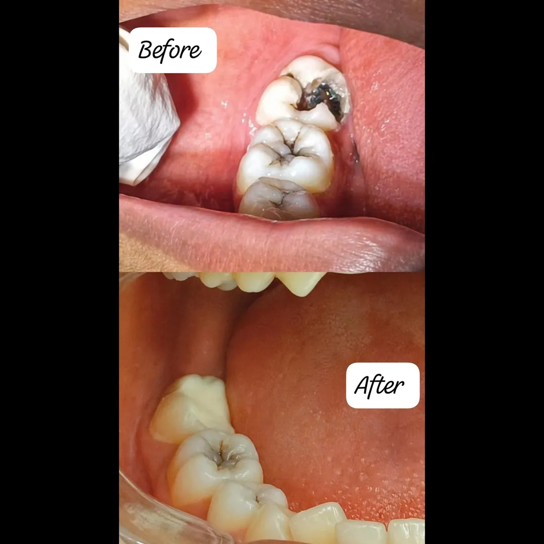 Cavity Treatment In Vashi