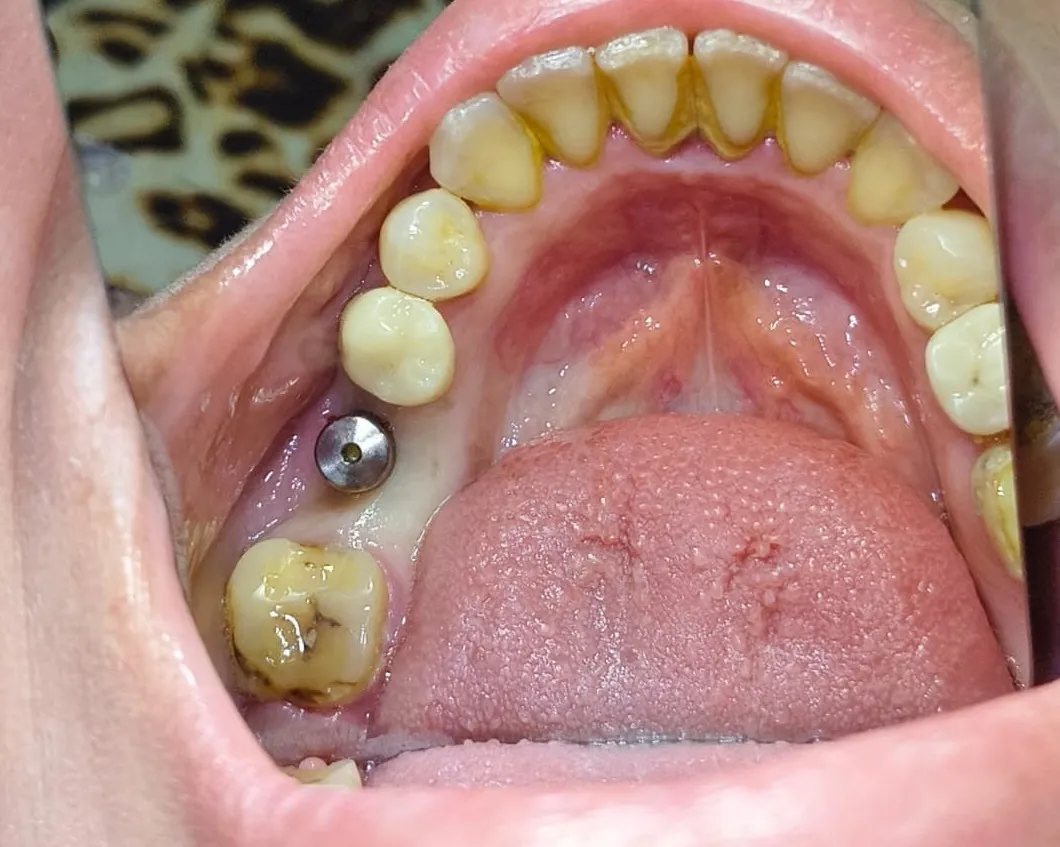 Why International Patients Choose Mumbai for Dental Implants