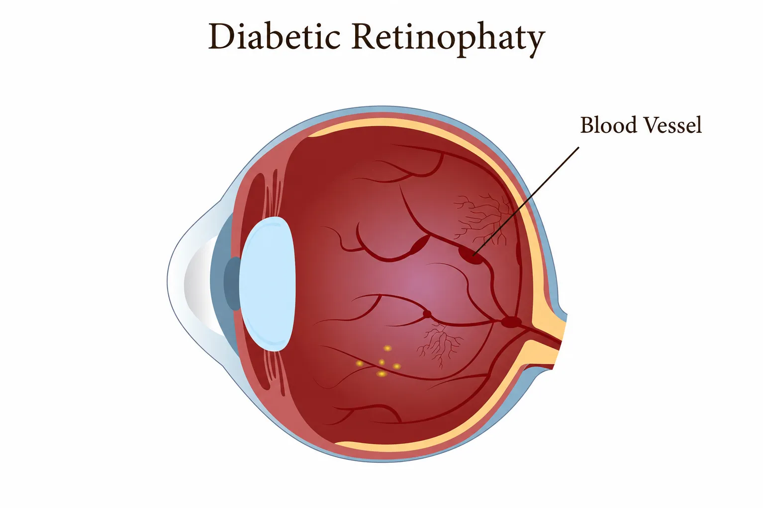 Diabetic Retinopathy Treatment in Chandigarh