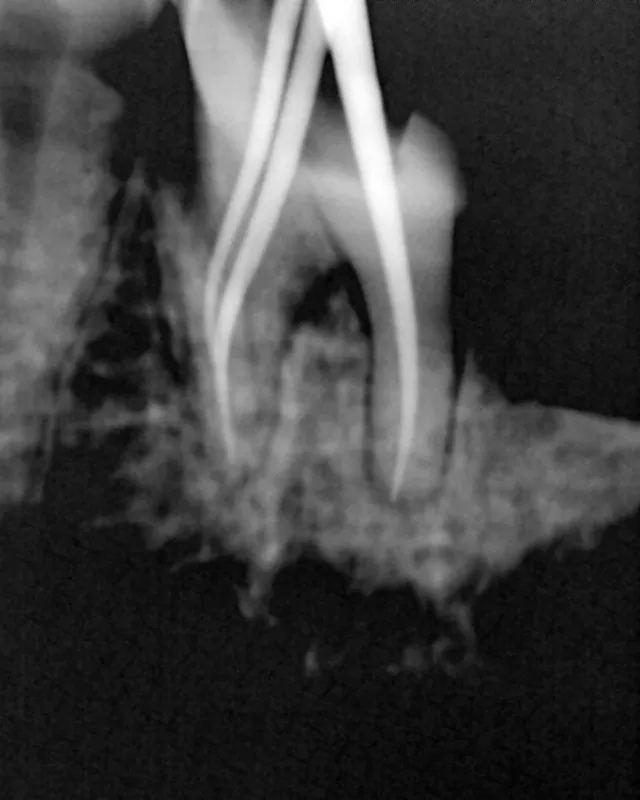 How Long Does Root Canal Treatment Take? Timeline Explained by Dentists in Mulund West Mumbai