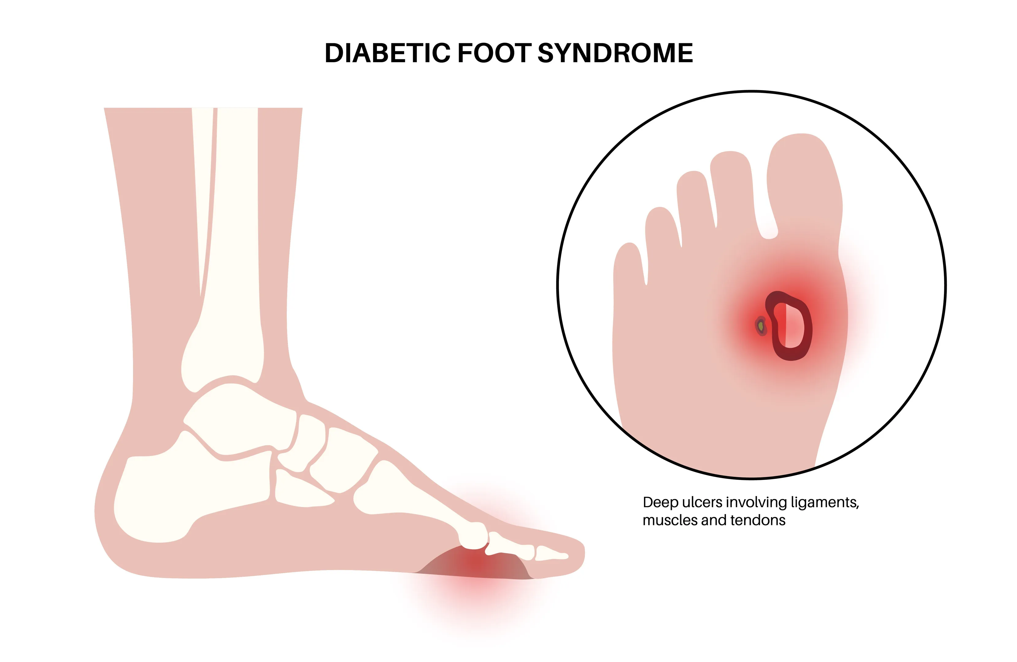 Diabetic Foot Treatment in Sewri for Better Wound Care Support
