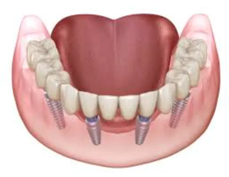Full Mouth Rehabilitation in Waghbil Road for Complete Smile Restoration