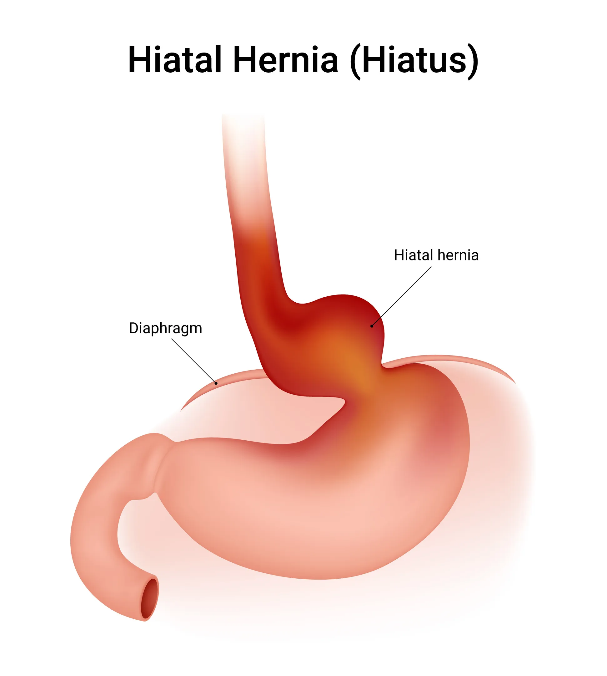 Surgery For Hiatal Hernia In Dombivli East for Long Term Digestive Relief
