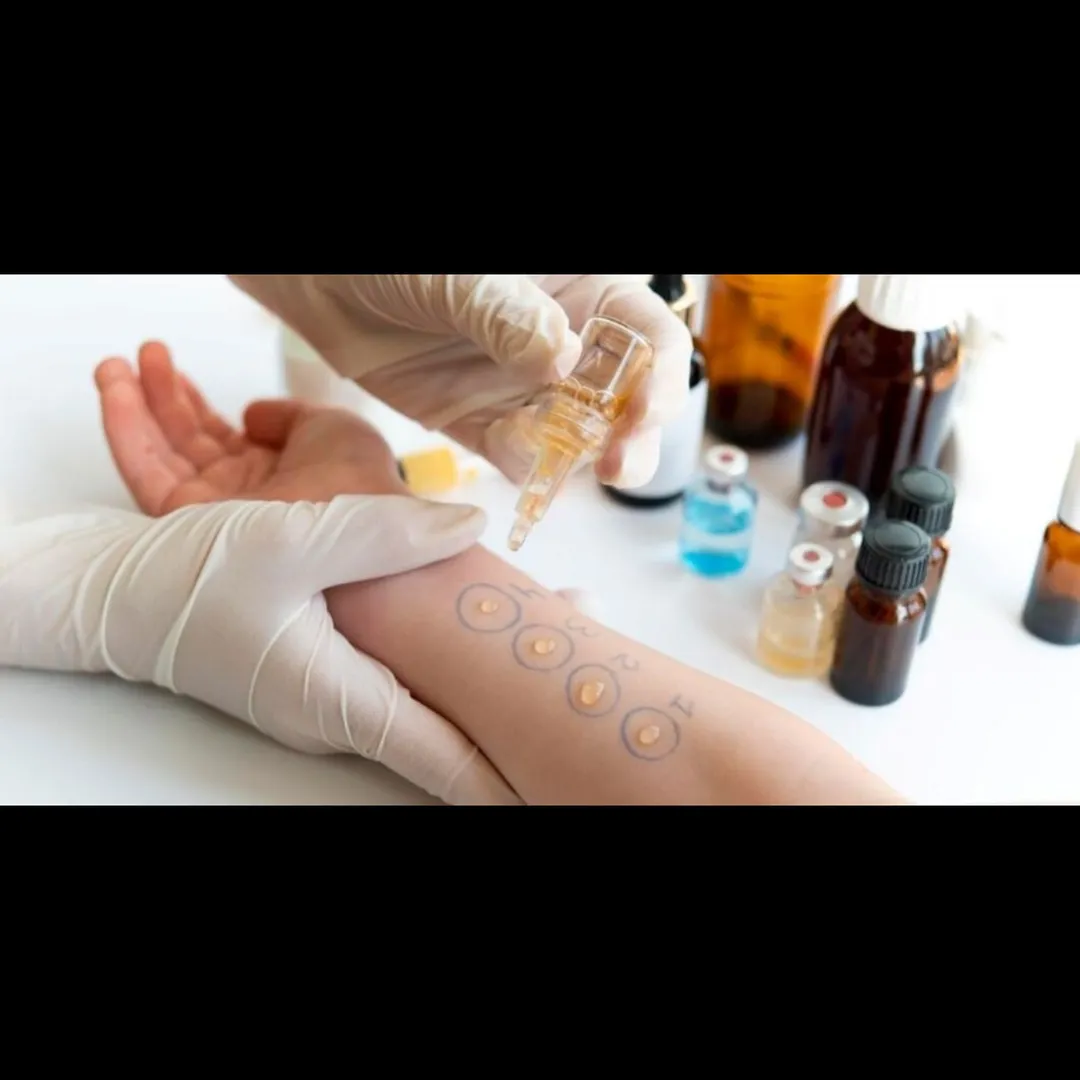 Skin Prick Test & Immunotherapy – Accurate Diagnosis, Long-Term Allergy Relief