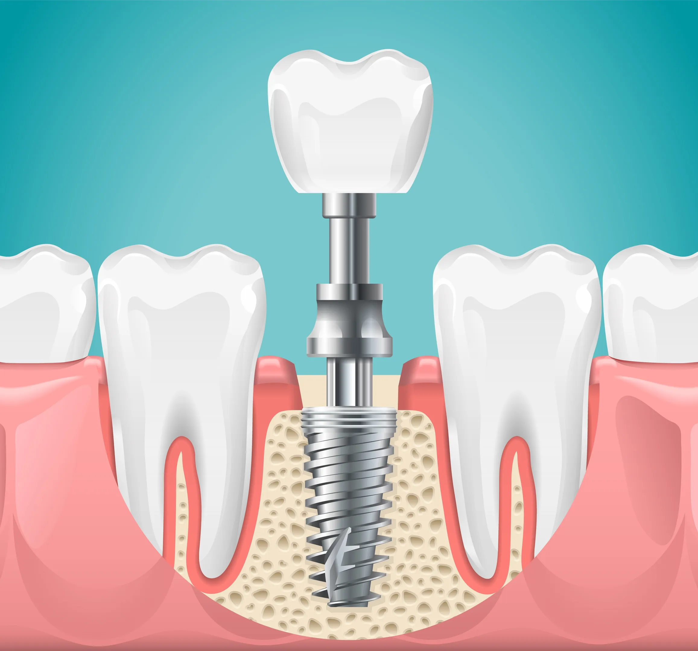 Tooth Implant Treatment in Upper Kharadi
